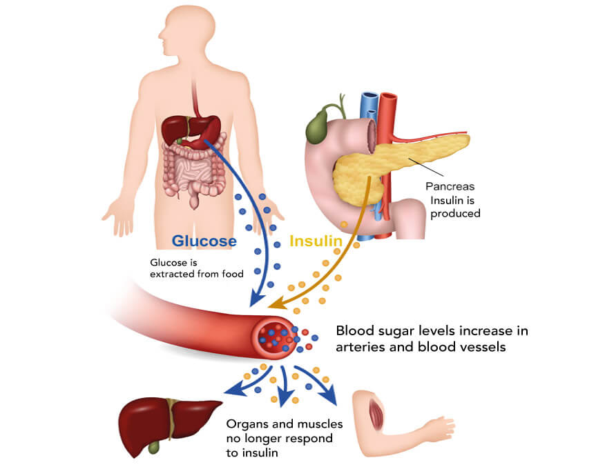 What is type 2 diabetes?